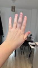 Have I broken my finger?