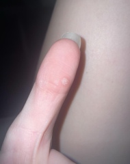 Anyone ever had verrucas?