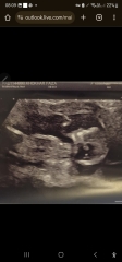 13w+4days scan girl or boy? Help!