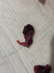 Is this a miscarriage or a blood clot?