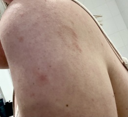Is this definitely ringworm?