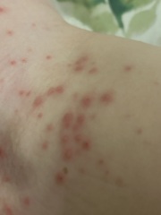 Infected chickenpox?