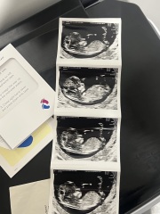 Baby gender nub or skull theory