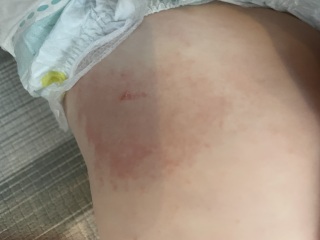 Has my DS had a Lymes disease tick bite
