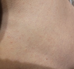 Rash and nausea