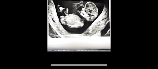 10 week scan, is this normal?