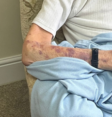 These Bruises