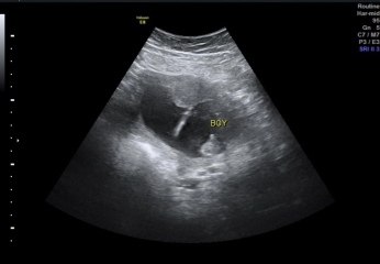 Gender scan at 15 week pics! ❤️