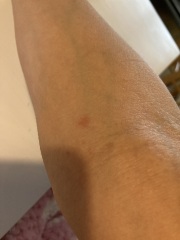 Resistant scabies?