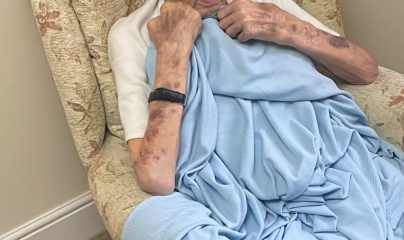 These Bruises