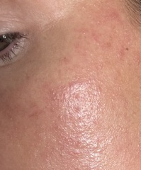 To ask for advice on dermaplaning rash - please help!