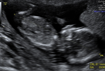 14 weeks, any nub?