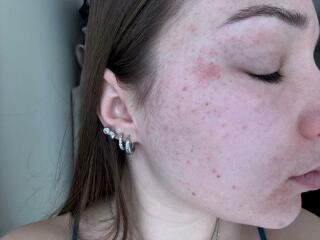 Rash & vomiting.