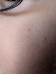 What is this spot on my child? Picture included