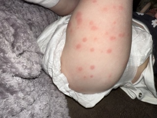 Chicken pox or something else?