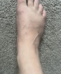 Scary raised veins in feet