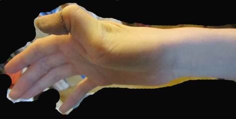 handwriting with thumb hypermobility