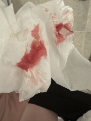 Implantation or period