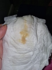 Pregnancy discharge