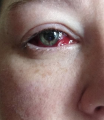 Please tell me about vitrectomy / Pneumatic retinopexy