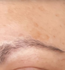 Monderma prescription for pigmentation