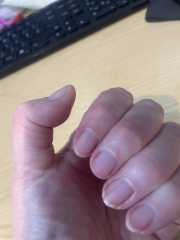 Proven treatments for natural peeling nails