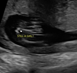 How accurate is an early gender scan at 16 weeks?