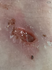 I though you might like these photos were my stitches came out early.