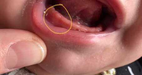 MIL kissed baby on the head with a coldsore
