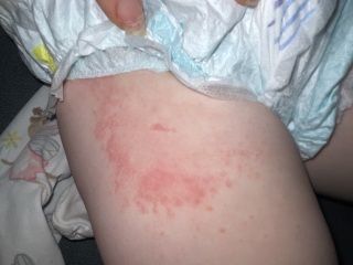 Has my DS had a Lymes disease tick bite