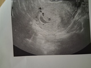 Can someone help me calculate my gestational sac size in mm?