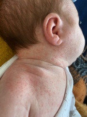 Is this baby acne or cmpa? Please help!