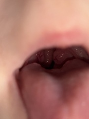 Toddler tonsils seem enlarged