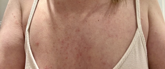 Is this definitely ringworm?