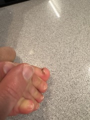 DD big toe