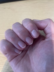Proven treatments for natural peeling nails