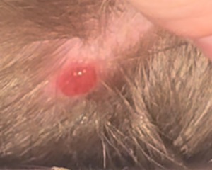 Suspicious nodule on 4y/o sons scalp