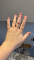 Have I broken my finger?