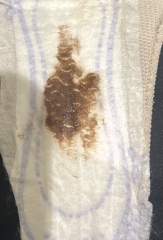 TMI image. 5 weeks 1 day am I having a miscarriage?