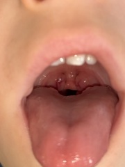 Toddler tonsils seem enlarged