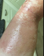 Need help with really sore skin.