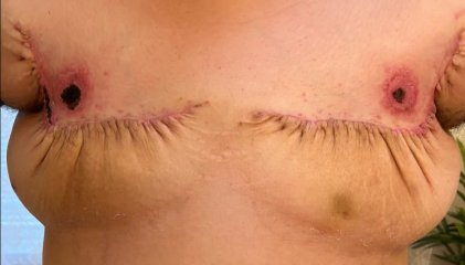 Friend wants top surgery