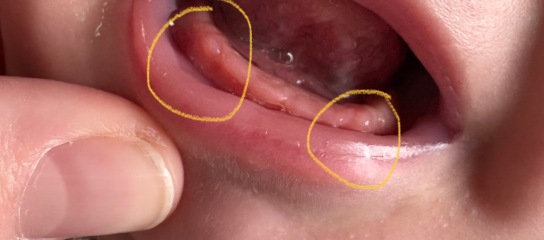 MIL kissed baby on the head with a coldsore