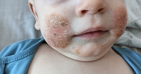 Baby eczema on face