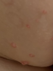 Any ideas what this could be - Molluscum contagiosum?