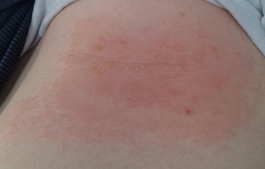 Is this shingles?!