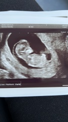 Fluid all around baby - 12 weeks