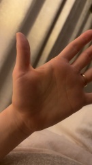 Tiny lump on thumb