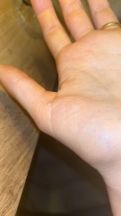 Tiny lump on thumb