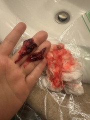 Suspected Miscarriage - but weeks indicator increasing